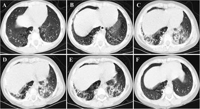 Successful tocilizumab treatment for rapidly progressive interstitial lung disease with anti-MDA5-positive juvenile dermatomyositis: a case report and literature review